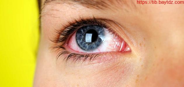 أضرار اللحام على صحة العين | بيت الطب