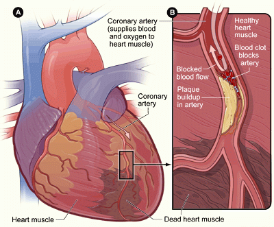 الخلايا الجذعية لعلاج أمراض القلب